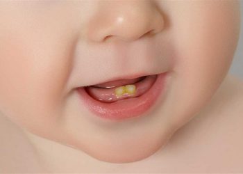 اصفرار أسنان الطفل