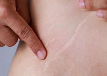 وأخيرا.. وصفة طبيعية للتخلص نهائيا من مشكل السيلوليت
