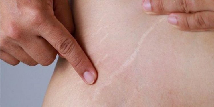 وأخيرا.. وصفة طبيعية للتخلص نهائيا من مشكل السيلوليت