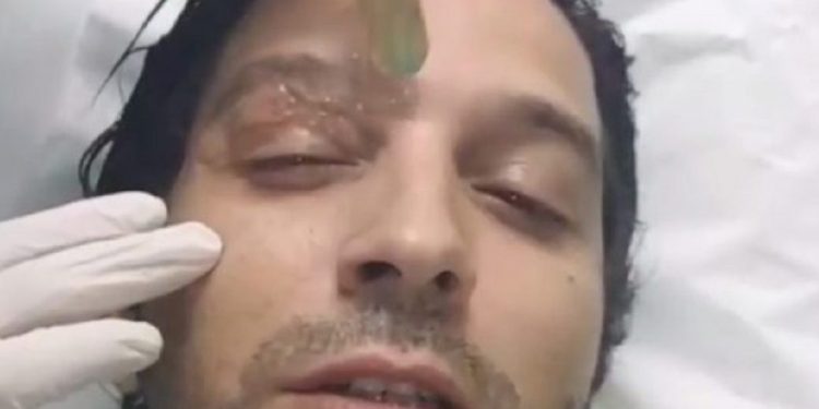 تعاطف كبير للمغاربة مع انس الباز في سلمات ابو البنات بسبب عينه