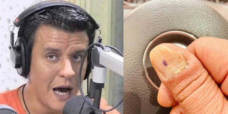 بسبب مرض أصبعه٠٠إعلامي مغربي يصرح بأنه يتعرض للتنمر (صورة)