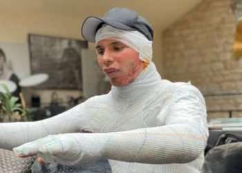 المصمم أوليفييه روستان يكشف عن إصابته بحروق خطيرة