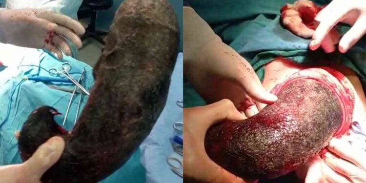 هذا ما وجده الاطباء في بطن فتاة!!