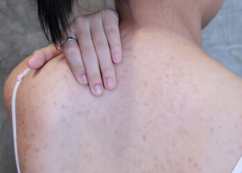 للتخلص من حبوب الجسم٠٠اتبعي هذه الخطوات