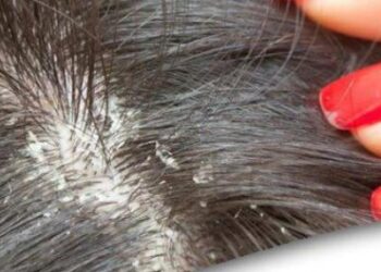 وداعا لقشرة الشعر٠٠ 9 وصفات طبيعية تخلصكي بشكل نهائي من هذا المشكل