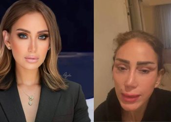 بسبب طبيب تجميل٠٠فنانة عربية تتعرض إلى تشويه وجهها (فيديو)