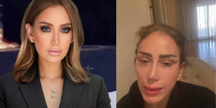 بسبب طبيب تجميل٠٠فنانة عربية تتعرض إلى تشويه وجهها (فيديو)