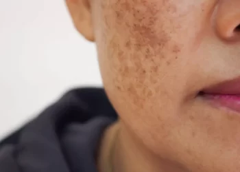 طرق طبيعية للتخلص من البقع السوداء على بشرتك
