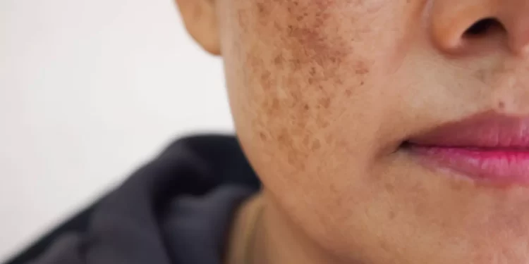 طرق طبيعية للتخلص من البقع السوداء على بشرتك