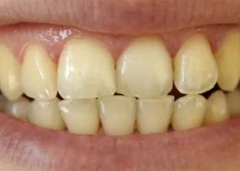 الابتسامة سر الجمال٠٠كيف تتخلص من اصفرار الأسنان بطرق آمنة وفعالة؟
