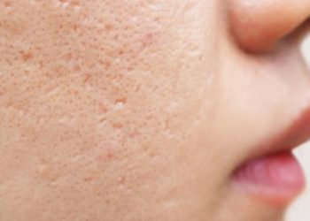 للتعامل مع الوجه المثقب..اتبعي هذه التعليمات