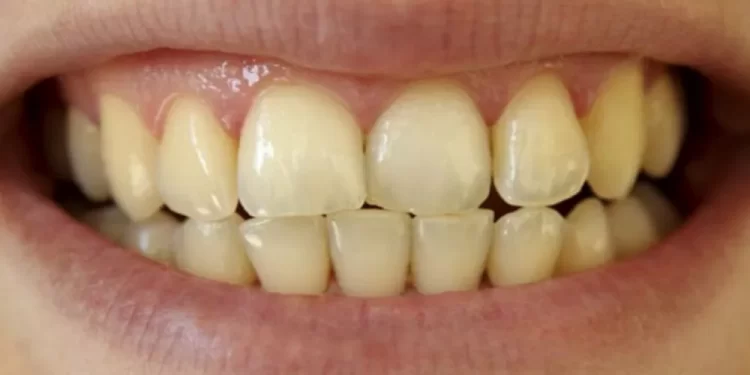 للتخلص من اصفرار الأسنان..اتبع النصائح التالية !