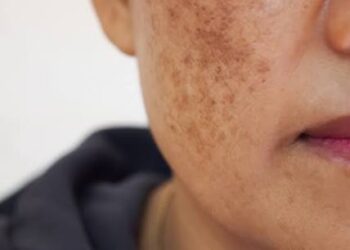 وداعا للبقع السوداء والكلف.. دليل العناية بالبشرة لإستعادة النضارة