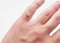 وصفات منزلية للتخلص من التولال.. حلول طبيعية قد تساعد في التخفيف من المشكلة