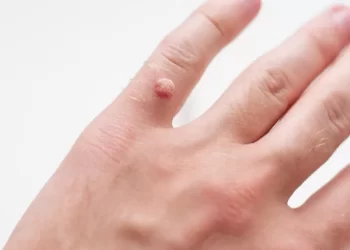 وصفات منزلية للتخلص من التولال.. حلول طبيعية قد تساعد في التخفيف من المشكلة