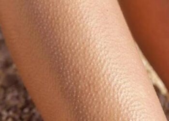 جلد الإوزة..كيف أتخلص من هذه المشكلة وأستعيد نعومة بشرتي؟